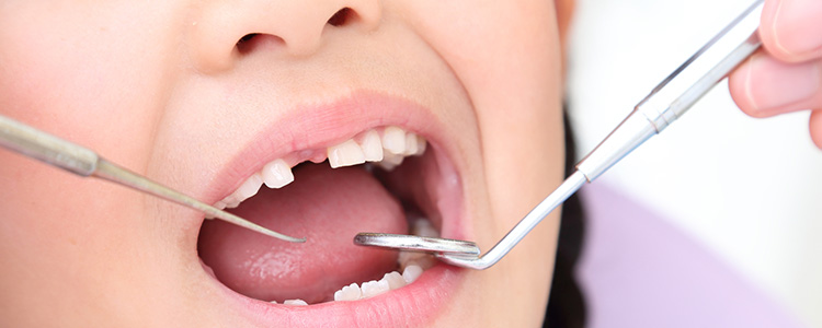 歯の溝を埋める虫歯予防